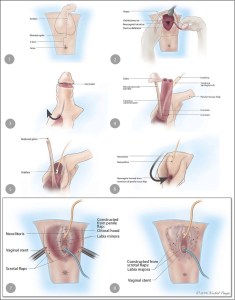 steps-of-penile-skin-inversion-vaginoplasty-used-with-permission-of-xochitl-vinaja